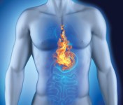 acidreflux-copy